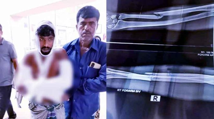 মাছ চুরি ঠেকাতে গিয়ে জেলের দুই হাত ভাঙল চোর